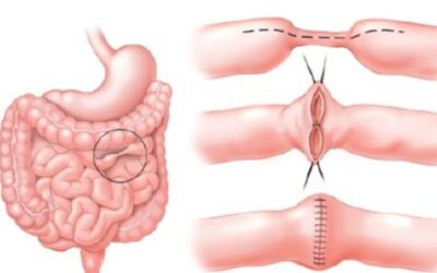 Cirurgia para Doença de Crohn, qual a indicação?