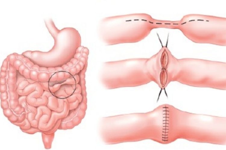 Cirurgia para Doença de Crohn, qual a indicação?