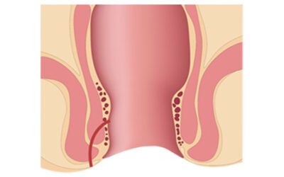Fístulas anais, tudo o que você precisa saber