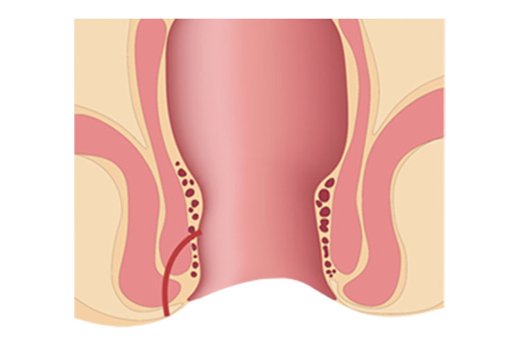 Fístulas anais, tudo o que você precisa saber