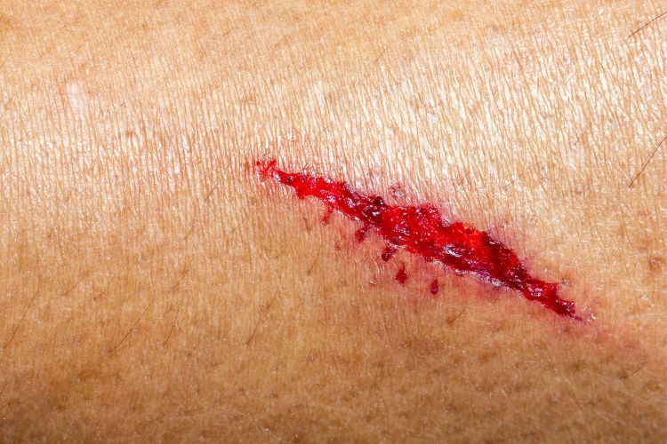 Por que a cirurgia no ânus deixa ferida aberta?