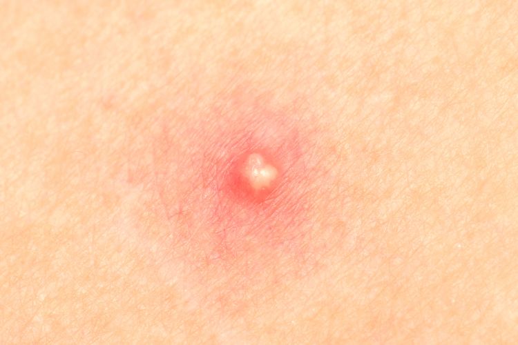 Furúnculo e abscesso perianal: é a mesma coisa?