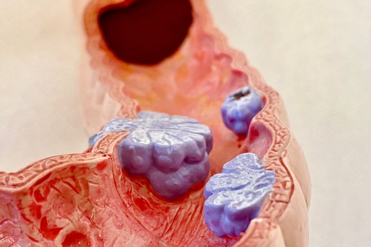 Divertículos e pólipos: entenda as diferenças entre eles