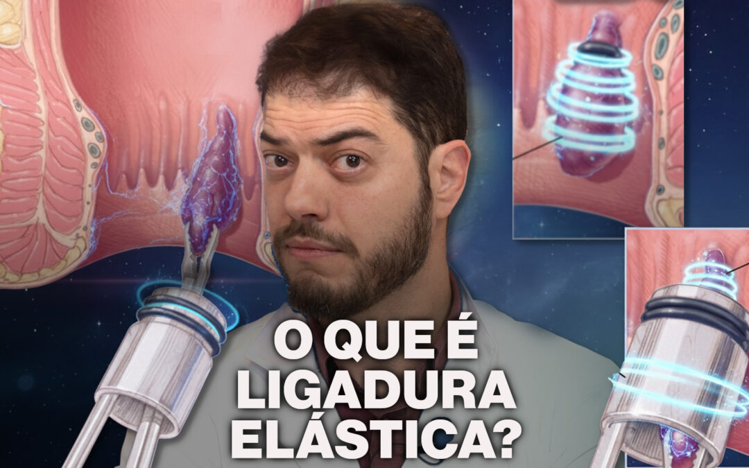 O que é  ligadura Elástica