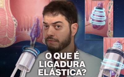 O que é  ligadura Elástica