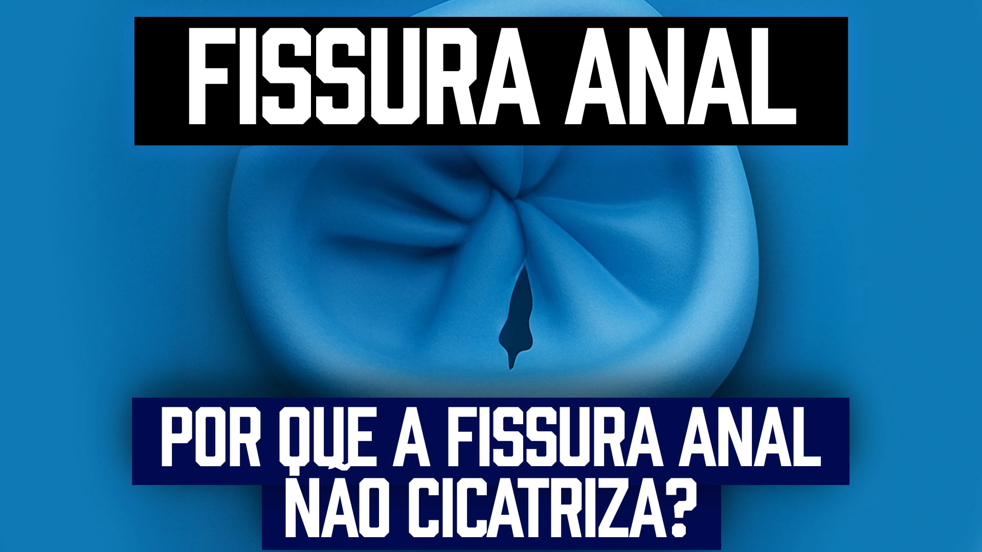 Como aplicar pomada para fissura anal corretamente no canal anal