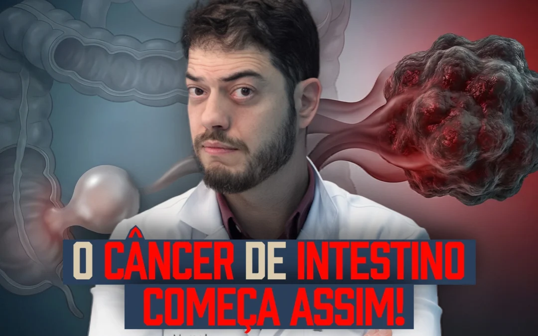 Como se desenvolve o câncer de intestino? Entenda do pólipo ao câncer (Guia Completo)