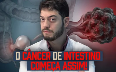Como se desenvolve o câncer de intestino? Entenda do pólipo ao câncer (Guia Completo)
