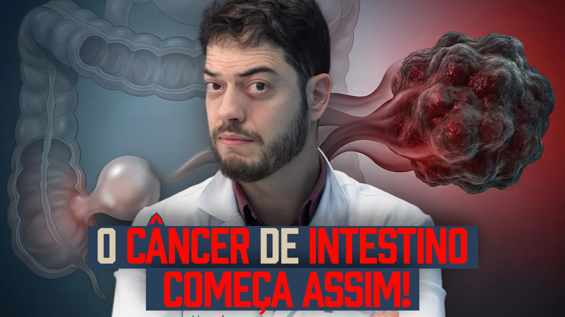 Quando fazer colonoscopia para prevenir o câncer de intestino: sequência de pólipo (adenoma) evoluindo até câncer