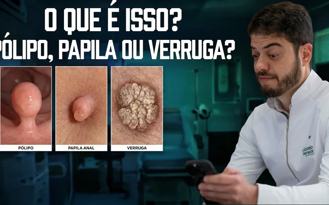 Pólipo, Papila Anal ou Verruga: Diferenças, Sintomas e Quando se Preocupar