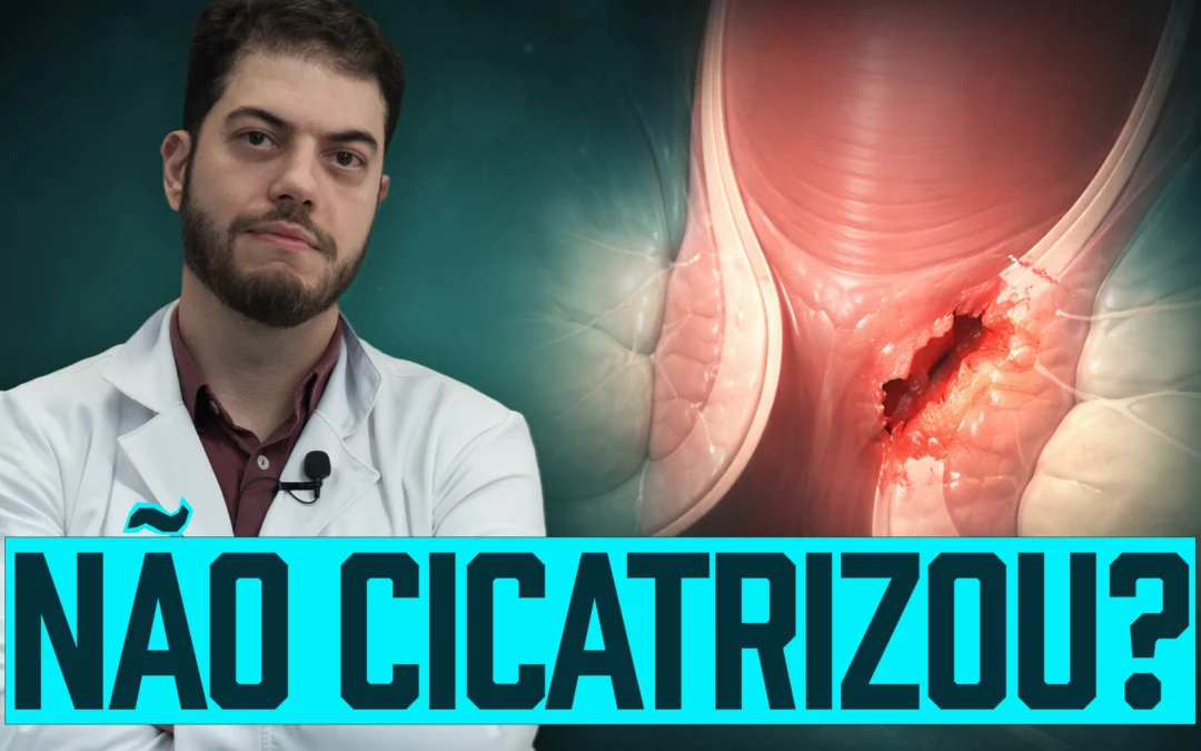 Fissura anal pós-operatória: dor persistente após cirurgia de hemorroida (Guia Completo)
