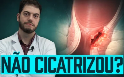 Fissura anal pós-operatória: dor persistente após cirurgia de hemorroida (Guia Completo)