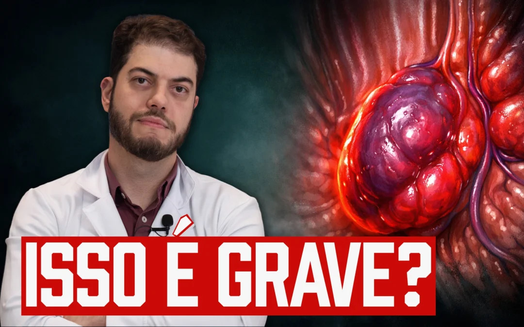 Trombose hemorroidária: o que é, por que dói e quando preocupar (Guia Completo)