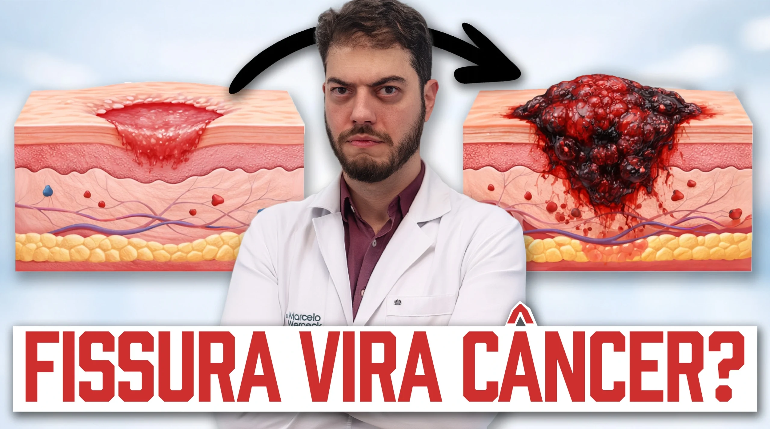 fissura anal vira câncer: entenda a diferença