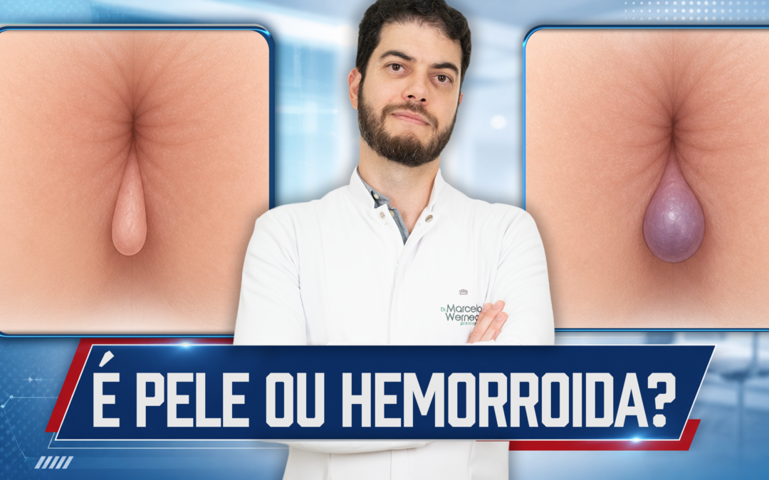 Plicoma ou hemorroida externa? Saiba identificar | Dr. Marcelo Werneck